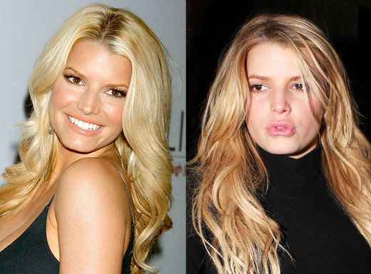 25 Stars Who Have Undergone Plastic Surgery: For Better or Worse?