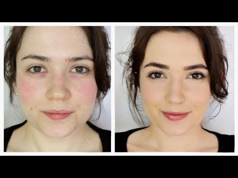 TheMakeupChair: How To Cover Rosacea/Redness